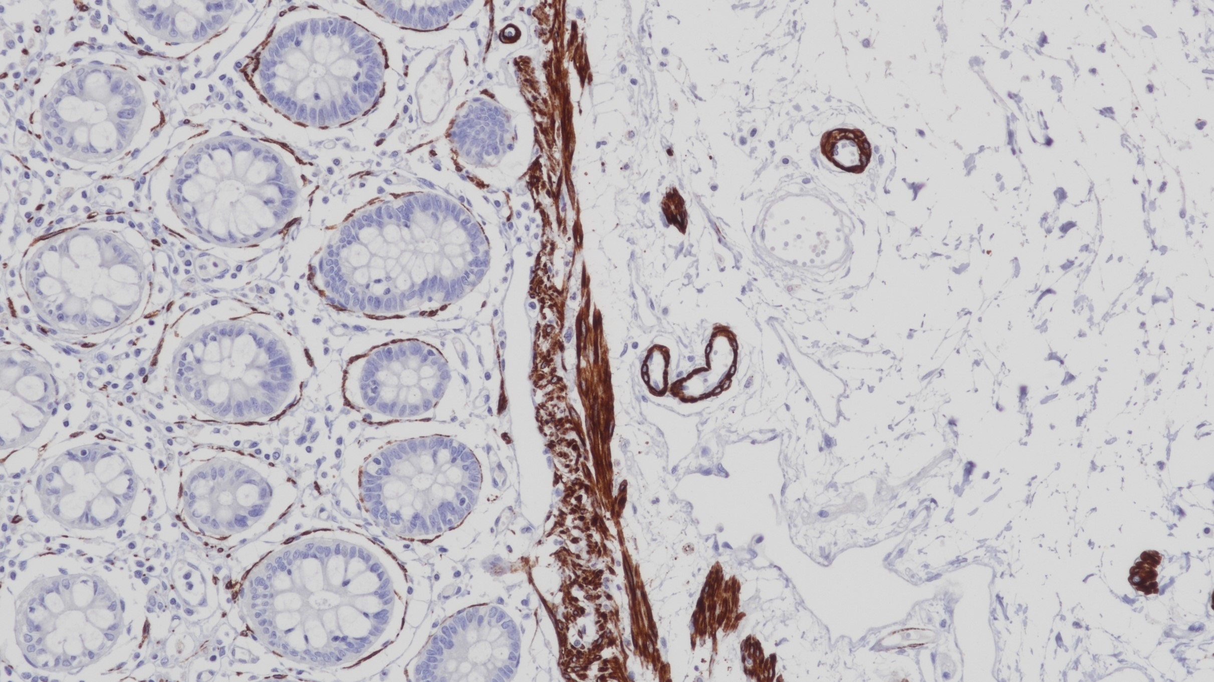 結(jié)腸Caldesmon(h-CALD)染色
